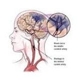 How a Stroke Happens? - National Stroke Association of Sri Lanka